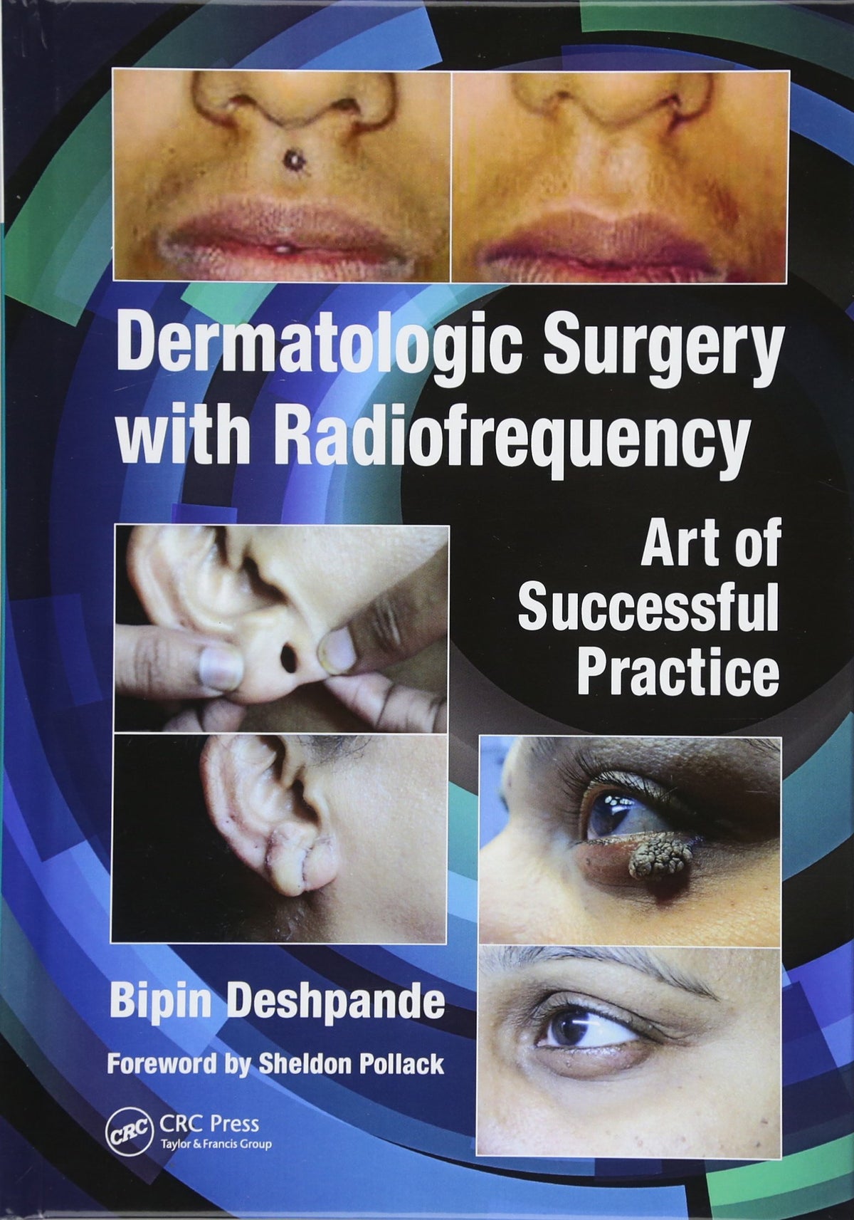 Dermatologic Surgery with Radiofrequency: Art of Successful Practice