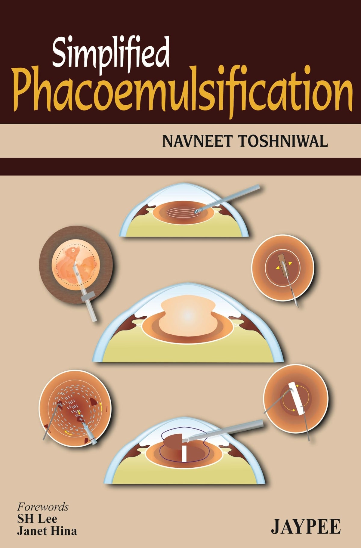 (OLD EDITION) Simplified Phacoemulsification