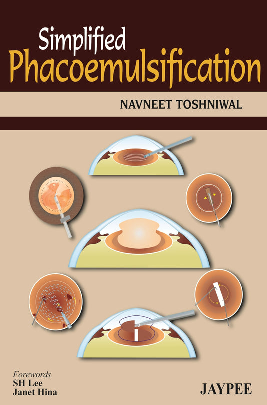 (OLD EDITION) Simplified Phacoemulsification